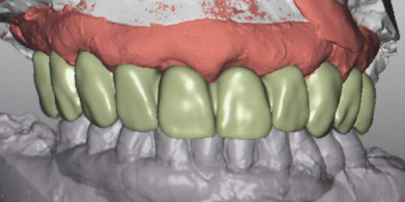 Dr. Alejandro Freer Ritter Implants Clinical Case