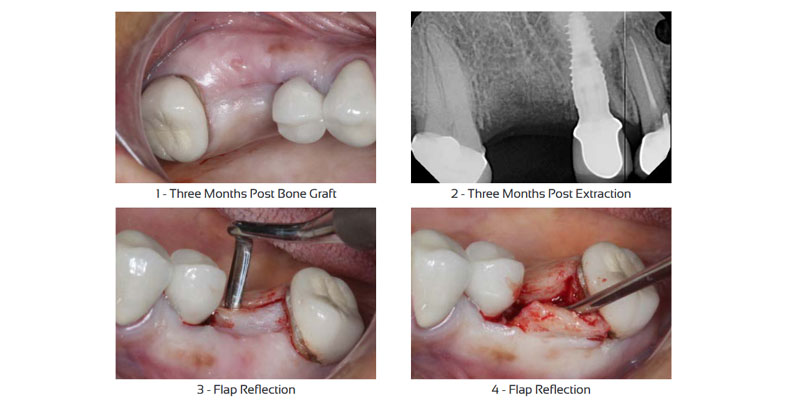 Kent Hamilton Ritter Implants