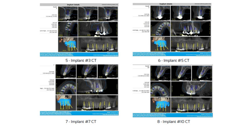 Kent Hamilton Ritter Implants