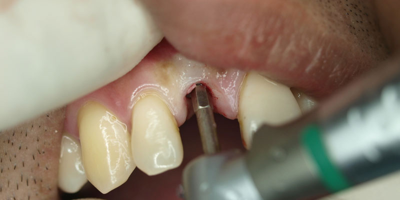 Dr. Firdaus Hanapiah Ritter Implants Clinical Cases