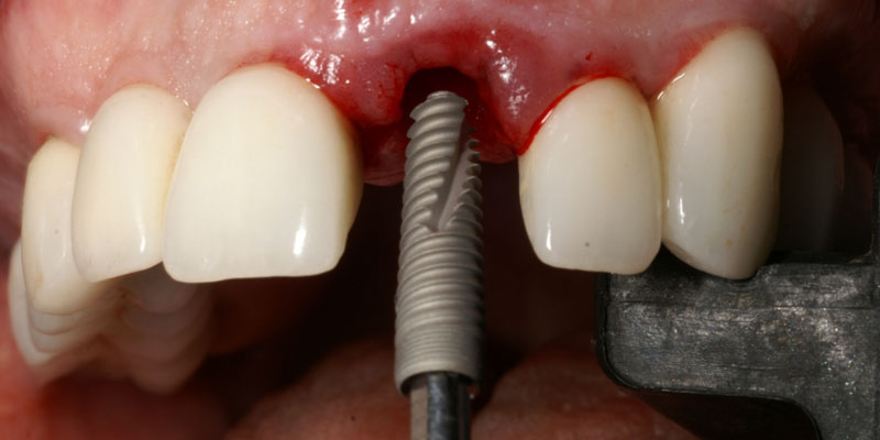 Dr. Maurice Salama Ritter Implants Clinical Case 2