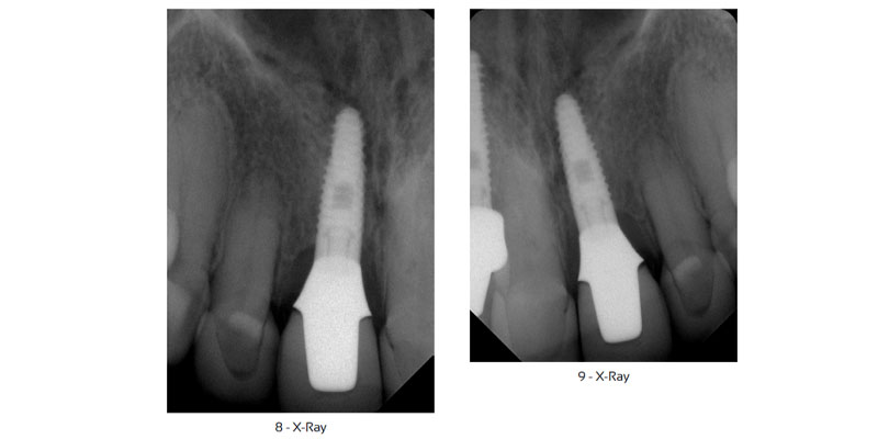 Dr. Maurice Salama Ritter Implants Clinical Case 3