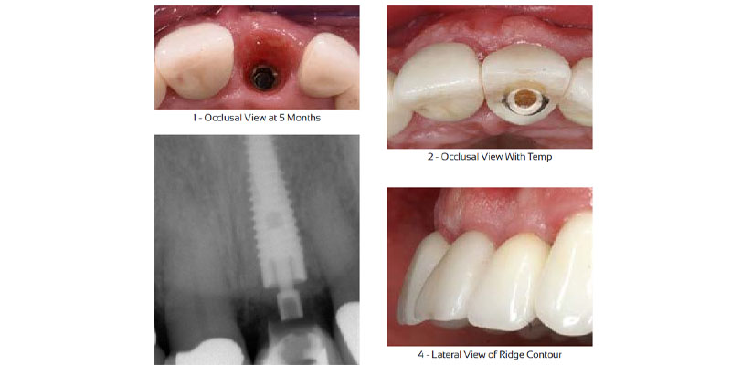 Dr. Maurice Salama Ritter Implants Clinical Case 6