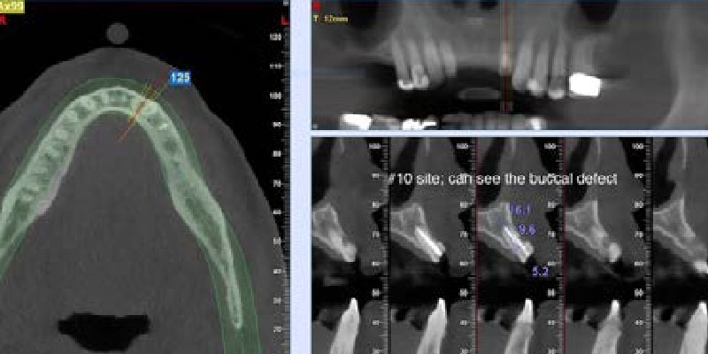 Dr. Ed Shapiro Ritter Implants Clinical Cases 1