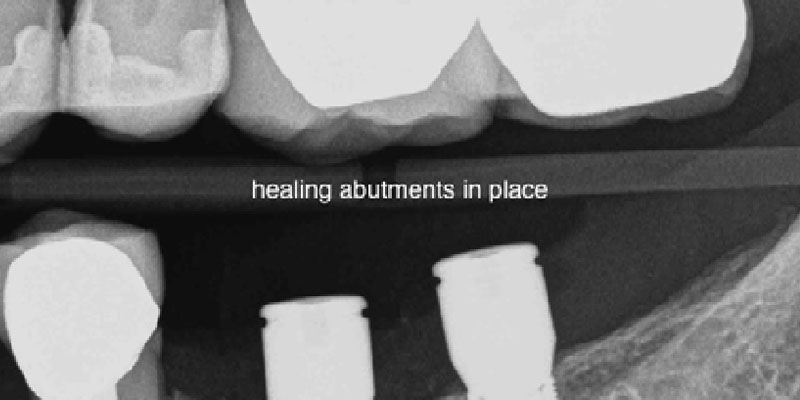 Dr. Ed Shapiro Ritter Implants Clinical Cases 2