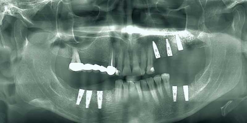 Dr. Swami Swaid Ritter Implants Clinical Cases