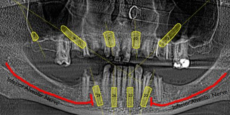 Dr. Wright Ritter Implants Clinical Case