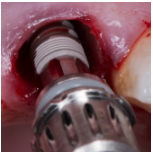 Dr. Manuel de la Rosa_Two Implants Post-Extraction