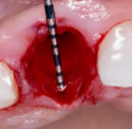 Placement Of Ritter Implants In The Anterior Maxilla With Bone Reduction And Osseodensification