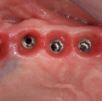 Posterior Reconstruction Ritter Spiral implant
